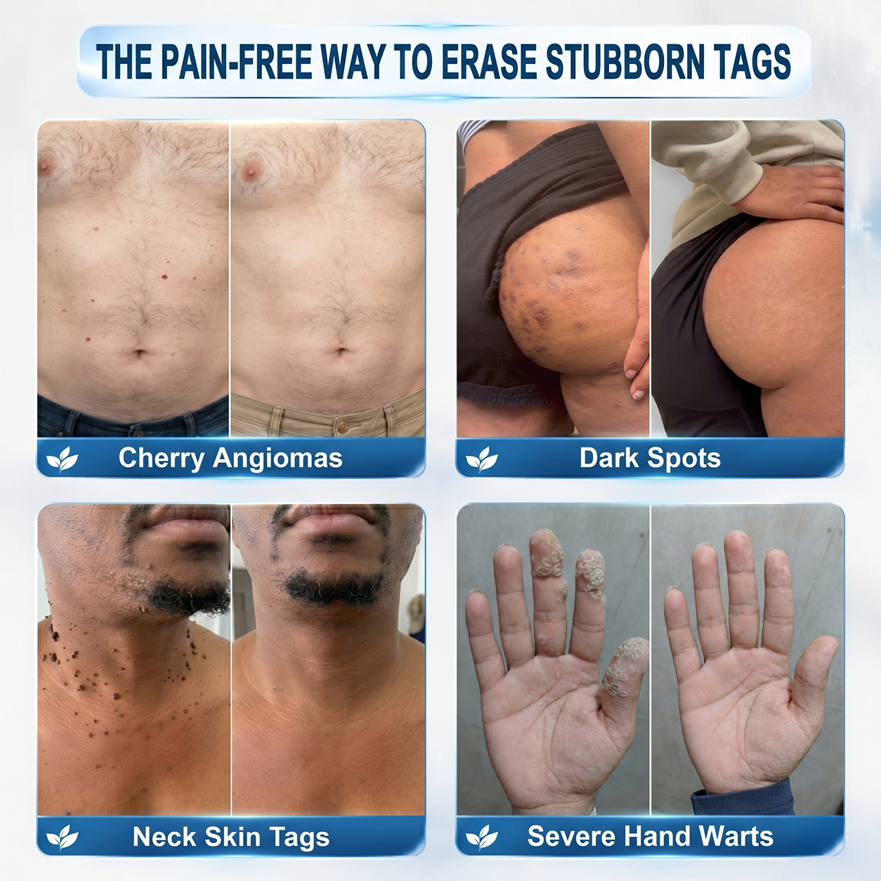 Official Store | 🎁🎁 𝐏i𝐜𝐝o® 7-Day Skin Tag & Spot Remover Serum