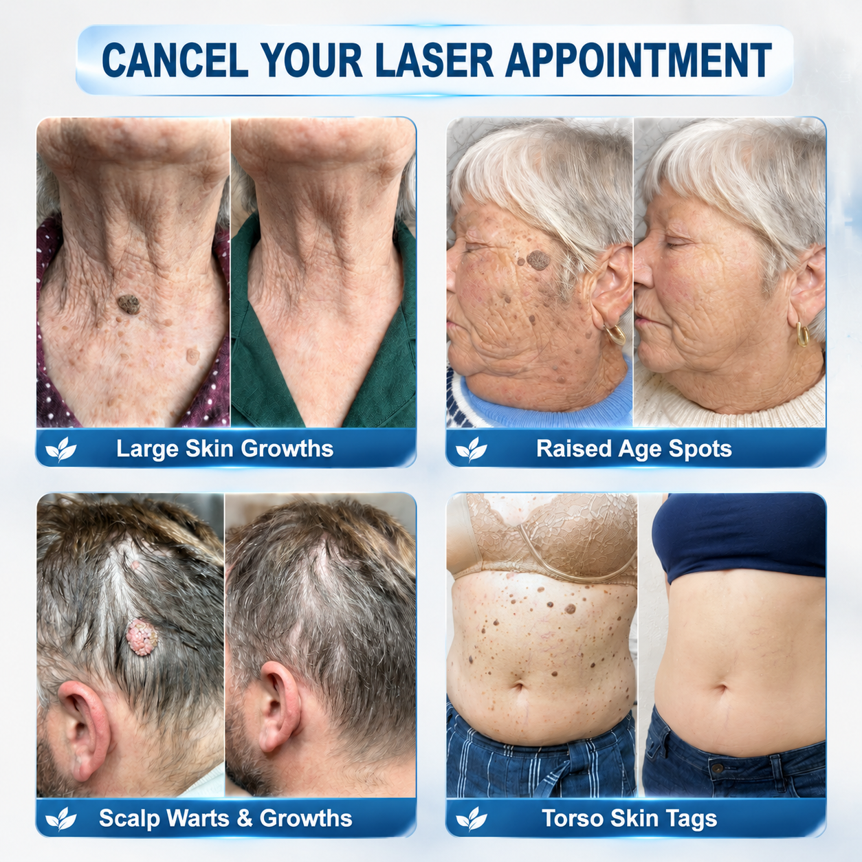 Official Store | 🎁🎁 𝐏i𝐜𝐝o® 7-Day Skin Tag & Spot Remover Serum