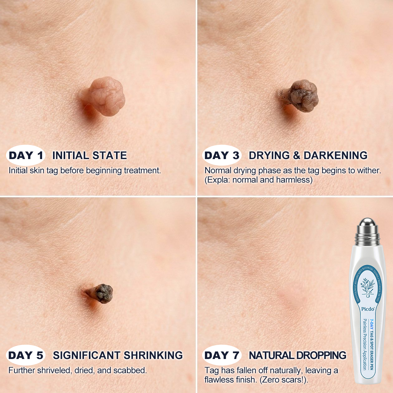 Official Store | 🎁🎁 𝐏i𝐜𝐝o® 7-Day Skin Tag & Spot Remover Serum
