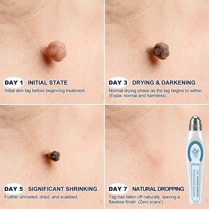 Official Store | 🎁🎁 𝐏i𝐜𝐝o® 7-Day Skin Tag & Spot Remover Serum